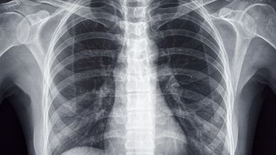 Image of chest x-ray.