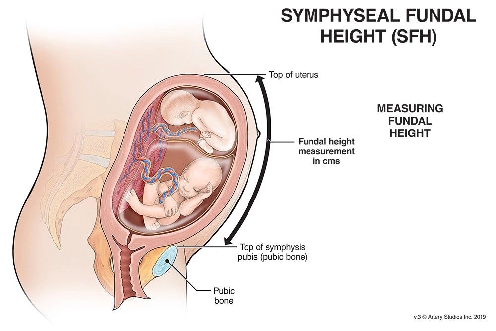 Symphyseal Fundal Height (SFH)