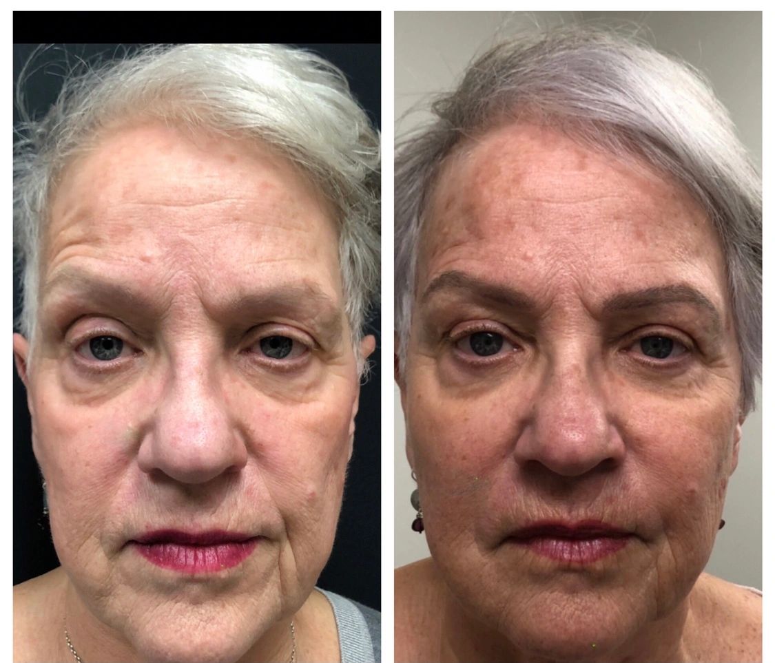 Natural transition from 2019 to 2023 with fillers and Botox.