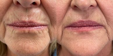 fine line filler for wrinkles at tailored medspa in southern utah