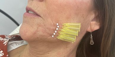 smooth pdo threads in st george utah for collagen production biostimulator