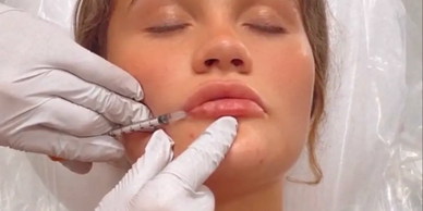 Lip flip in St George, Utah using botox lip filler