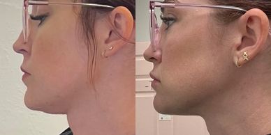 Neffertiti neck lift using botox for double chin neck tightening defined jawline southern utah