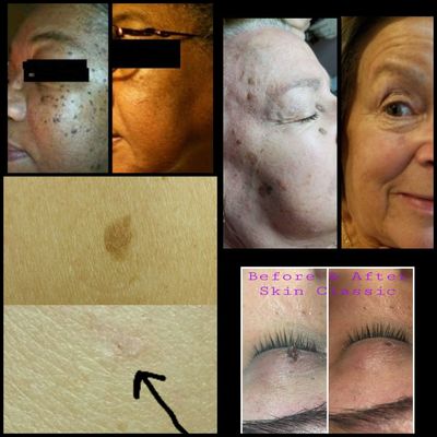 skin tag removal treatments for skin tags in Wilmington, DE and Newark, DE