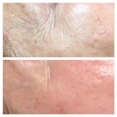 microneedling collagen large pores acne marks