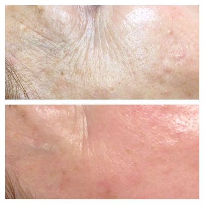microneedling in Wilmington, DE, Microneedling in 19803, CK Skin spa microneedling, medical spa 