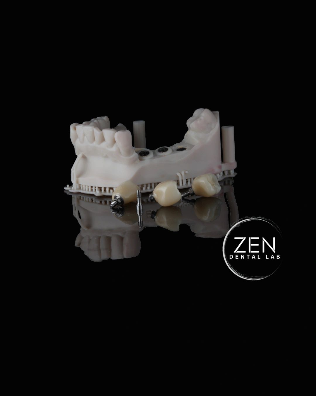 Dental model with implant screws and crowns.