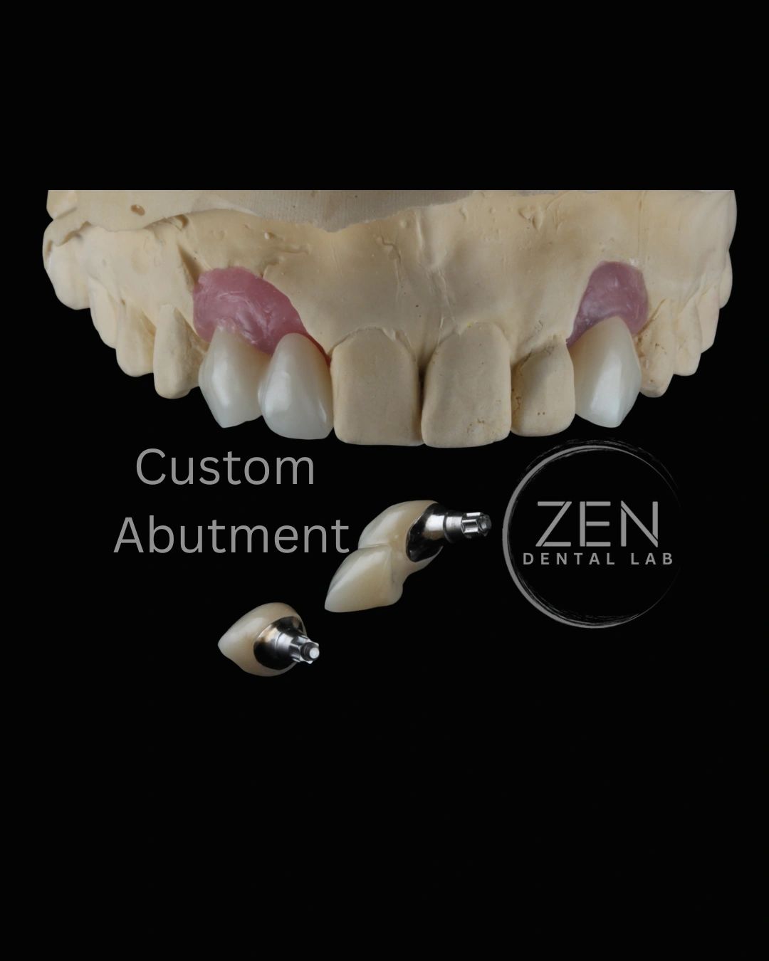 Dental model with custom abutment implants.