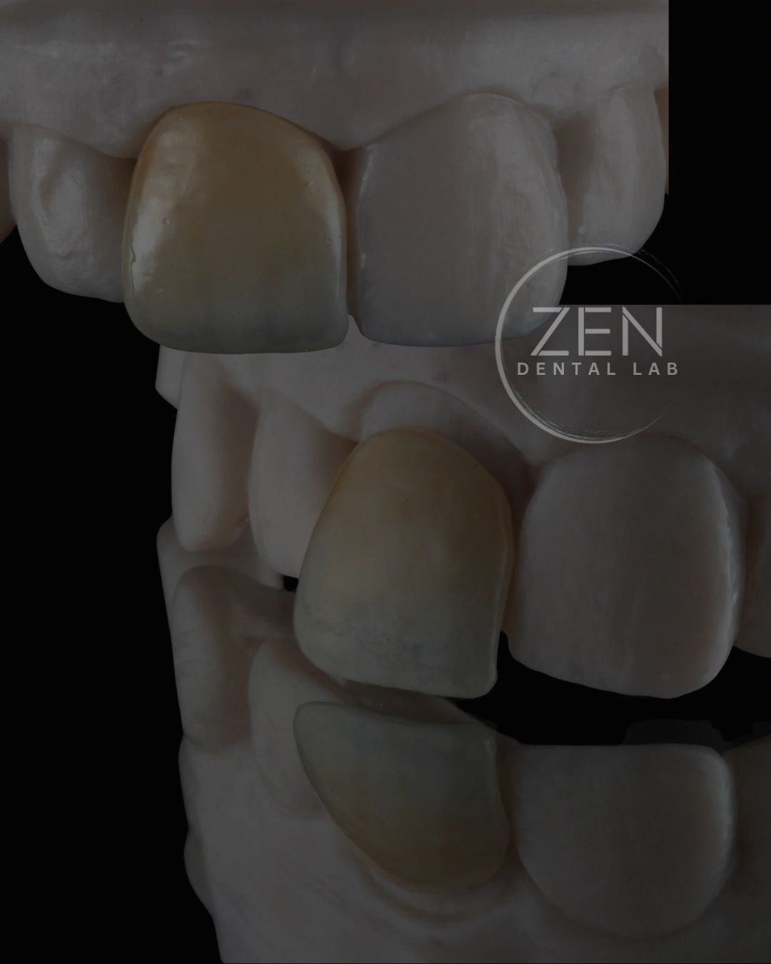 Close-up of dental veneers on a model.