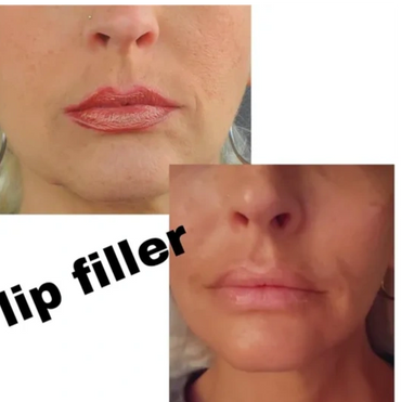 Before and after photos of lip filler treatment showing fuller lips.