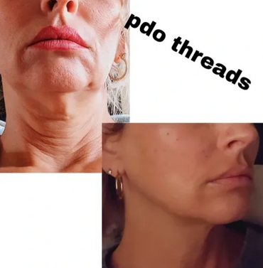 Before and after PDO threads treatment showing neck and jawline improvement.