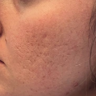 Close-up of skin with acne scars and texture irregularities.
