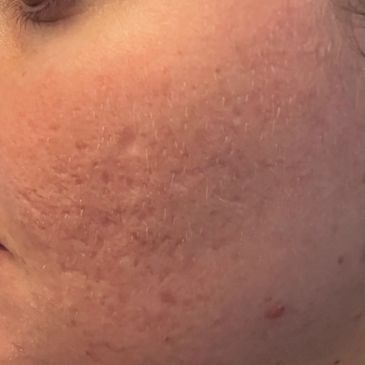 Close-up of skin with acne scars and texture irregularities.