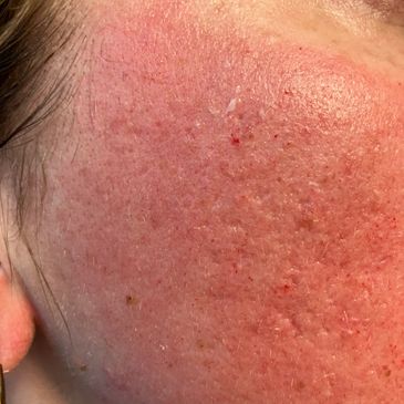 Close-up of red, irritated skin with acne scars and blemishes on the cheek.