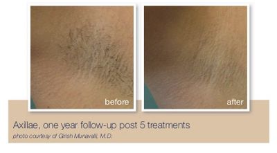 Laser Hair Medspa Laser Hair Removal Efc Medspa Spring Texas