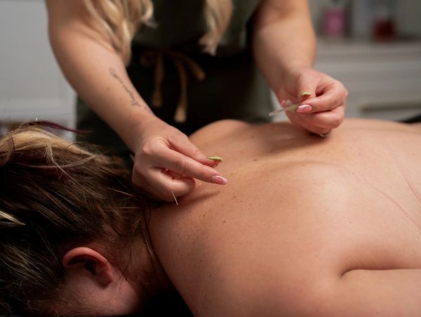 Person receiving acupuncture on their back.