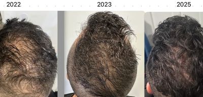 Improvement in hair density, color, and reduction of balding over years, using prp.