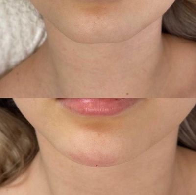 Natural-looking chin filler results at Chelski-Aesthetics, Pimlico London