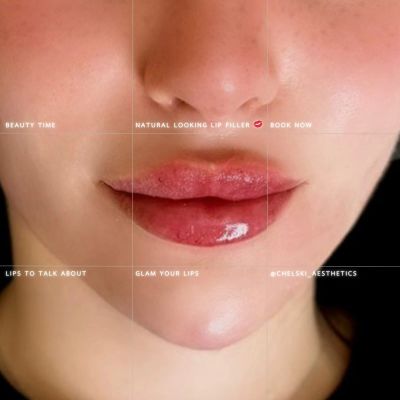 Natural-looking lip filler results at Chelski-Aesthetics, Pimlico London