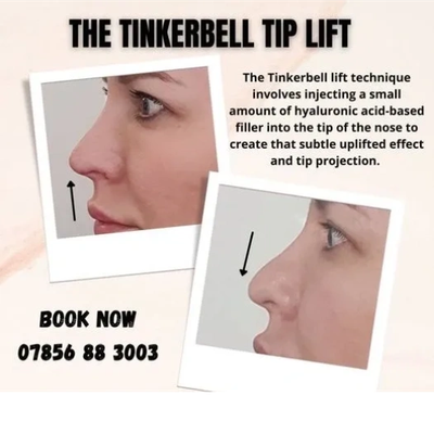 Liquid rhinoplasty results at Chelski-Aesthetics, Pimlico London
