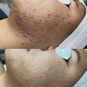 Before and after acne treatment on the cheek showing significant skin improvement.