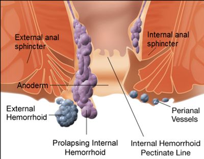 Hemorrhoid pain relief