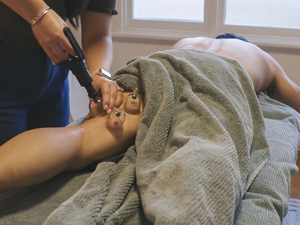 cupping as part of osteopathy treatment for leg pain