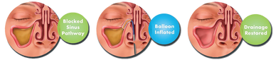 Balloon SInuplasty Dilation Westchester White Plains