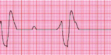 In EKG class you will learn to read this rhythm strip 