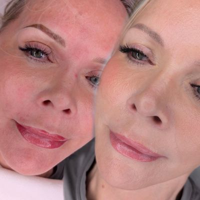 Lip blush cosmetic tattoo before and after - Frankston East