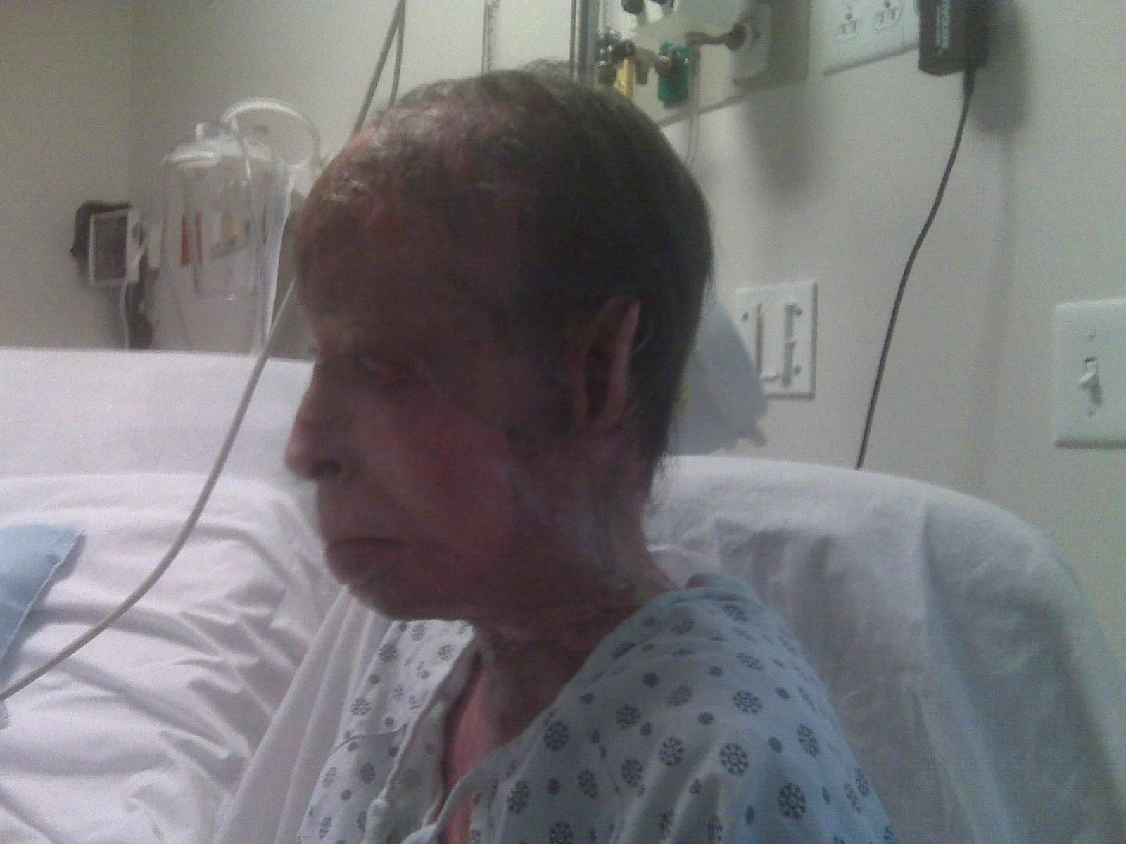 Agnes in 2008 after 5 months in the burn unit
