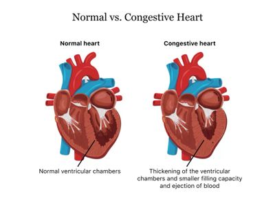 Congestive Heart Failure