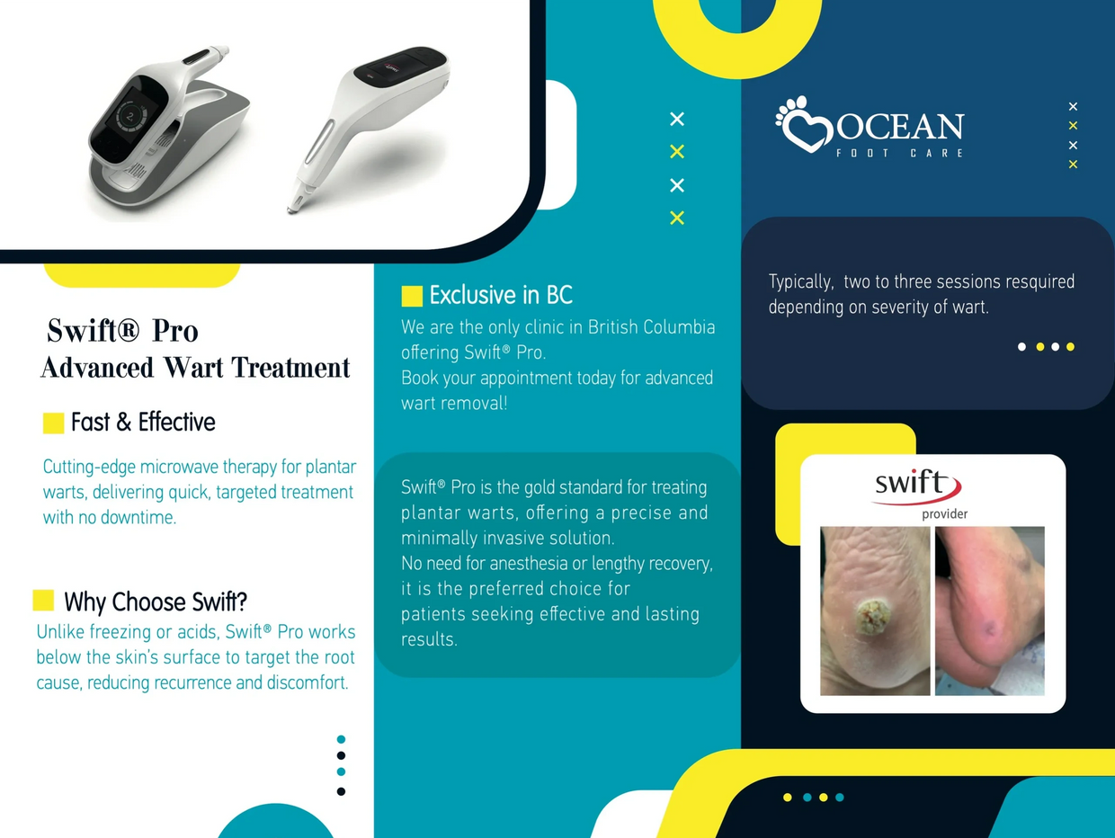 WART TREATMENT at Ocean Foot Care
