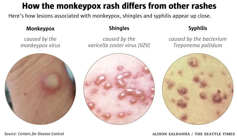 What Are the Symptoms of Monkeypox?