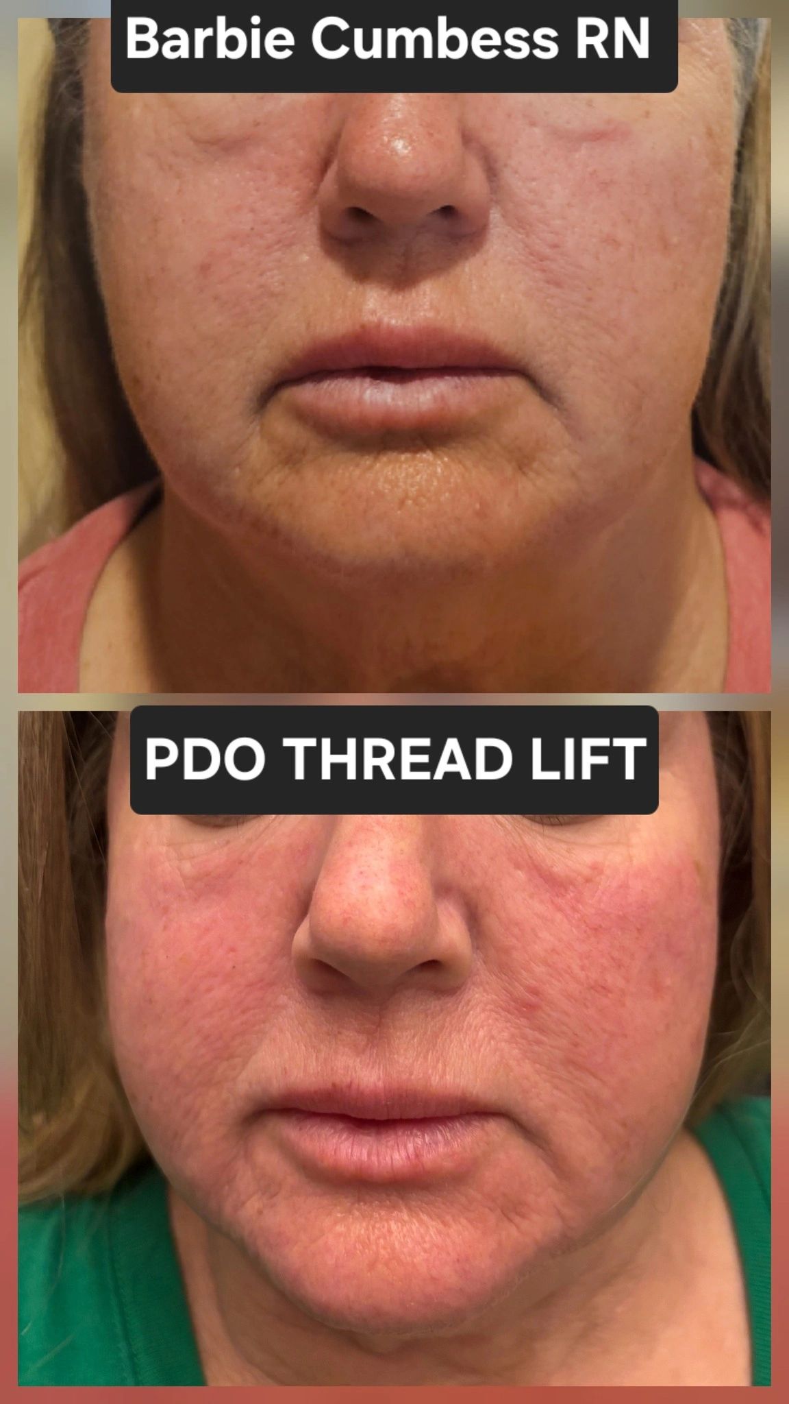 Before and after PDO thread lift showing facial skin improvement.