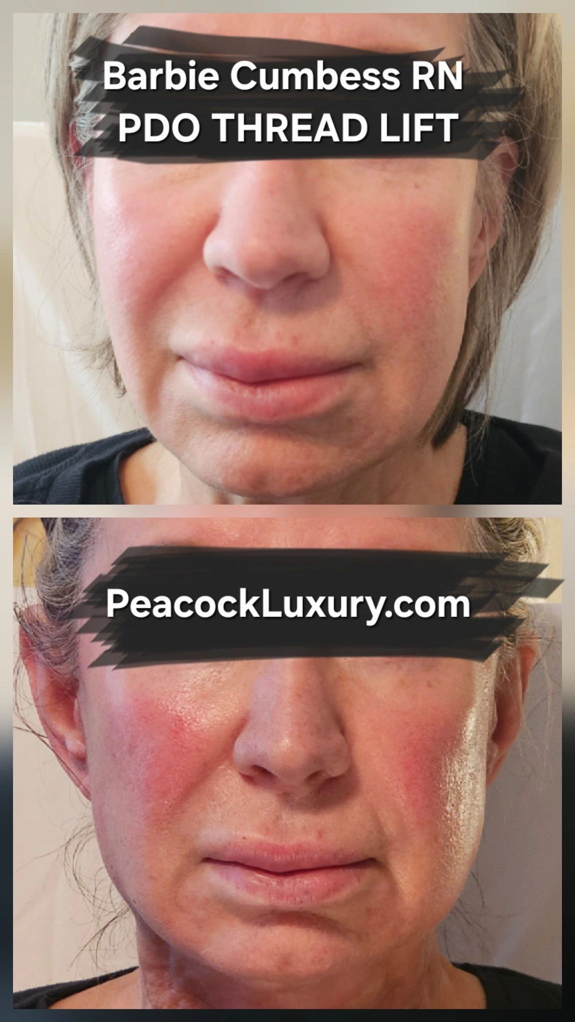 Before and after photos of a PDO thread lift facial treatment.