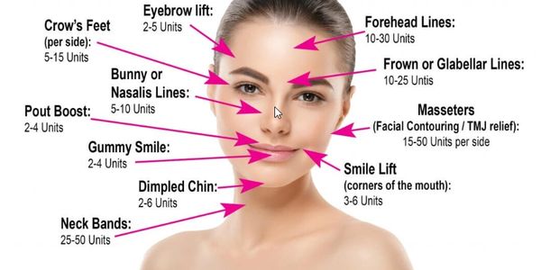Diagram showing Botox unit recommendations for different facial areas on a woman's face.