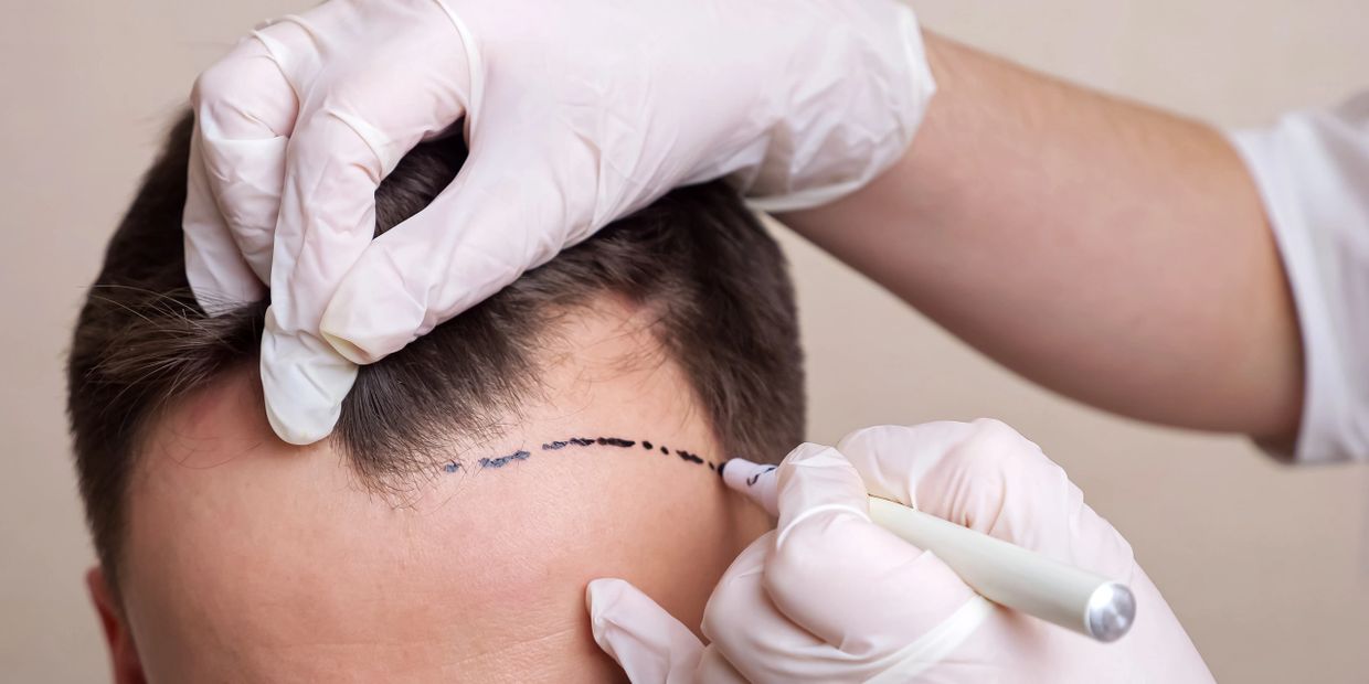 Mens head showing a receded hair line, while a a new hairline being drawn by hair transplant surgeon