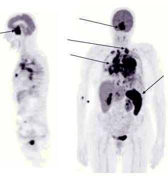 PET SCAN showing neoplastic deposits