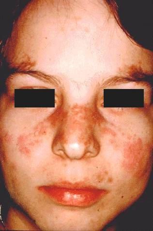 Discoid Lupus Butterfly Rash