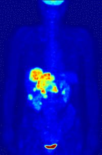 PET Scan