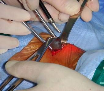 video assisted thyroidectomy