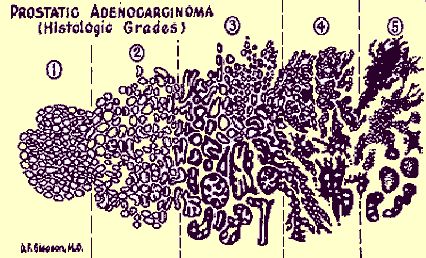 Gleason Score Schematic Drawing