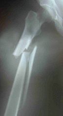 Fosamax induced femur fracture