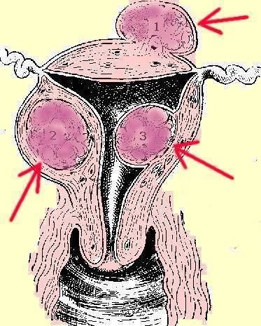 Three Uterine Fibroids Red Arrows