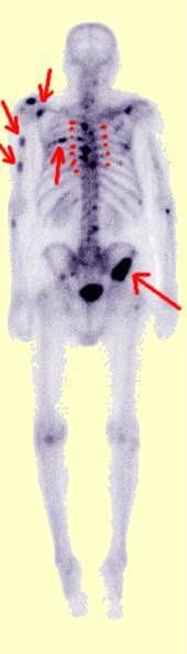 Bone Scan showing Prostate cancer bone mets
