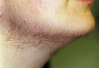 Hirsutism PCOS Polycystic Ovary Syndrome
