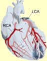 Heart Attack with Occluded Artery 