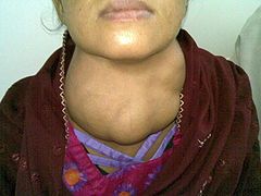 Goiter casued by Iodine deficiency jeffrey dach md