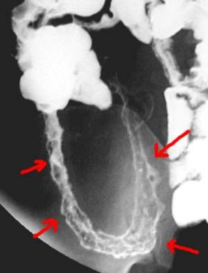 crohns disease distal ileum courtesy jeffrey dach md